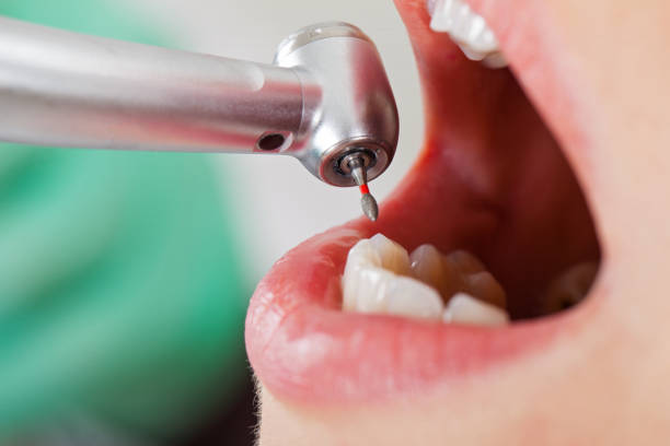 Best Emergency Root Canal Treatment in Lake Arbor, MD